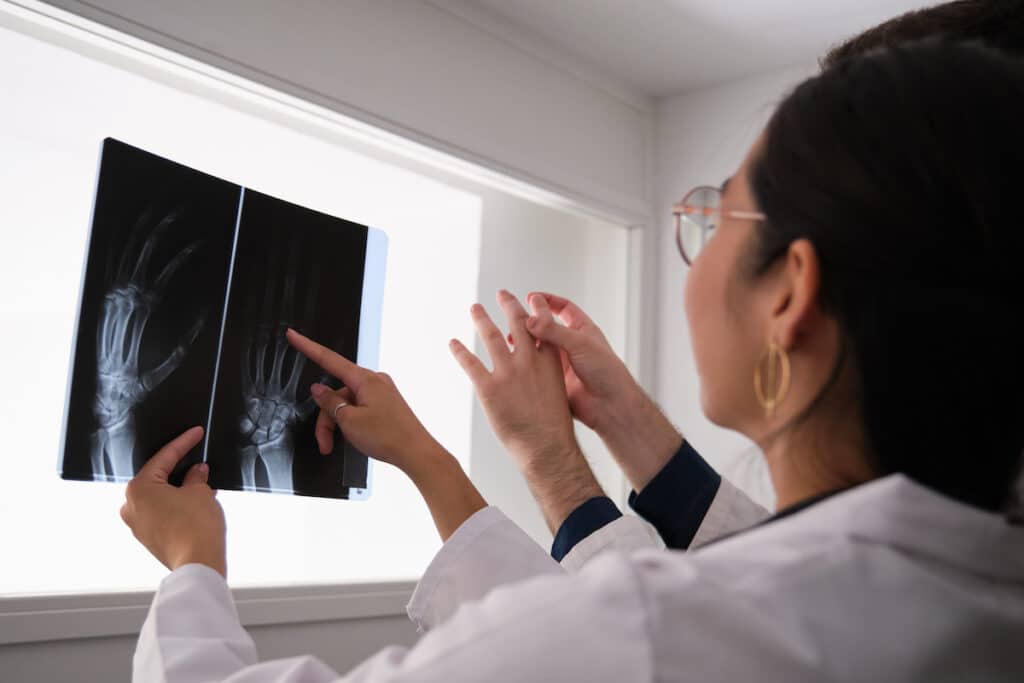 Rheumatology doctors examining hand x-ray image for rheumatoid arthritis.